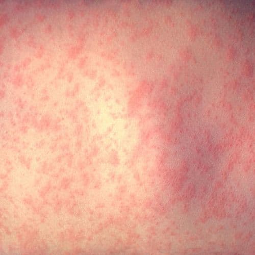 Dr. Birx to Newsmax: Unvaccinated Behind Spike in Measles Cases
