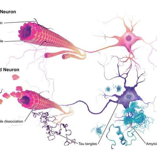 Senolytics offer hope for more precise Alzheimer's treatments
